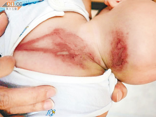 皮膚出現紅腫及水泡