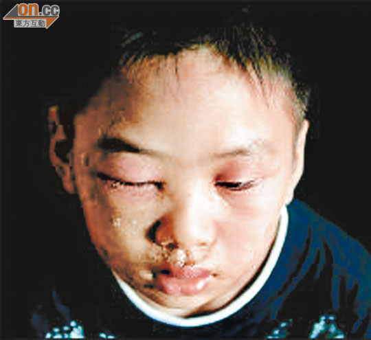 因接觸隱翅蟲毒液而皮膚潰爛