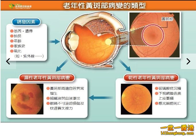 老年性黃斑部病變.jpg