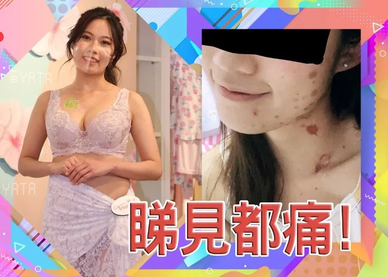 波波煎腸仔出事 搞到二級燒傷險毁容！.jpg