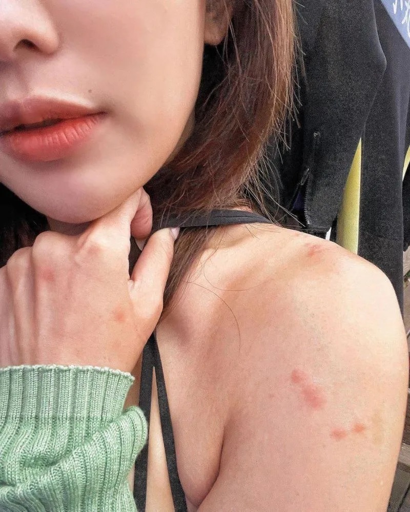 4 壯壯身上布滿被水母螫咬的紅斑！（圖／翻攝壯壯FB）.jpg