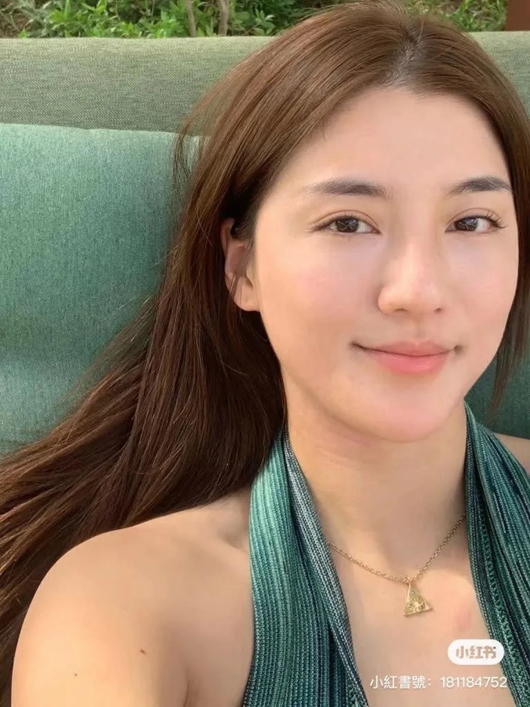 5 吳千語臉頰跟脖子長了一大片的濕疹，這張相已經康復不少！.jpg