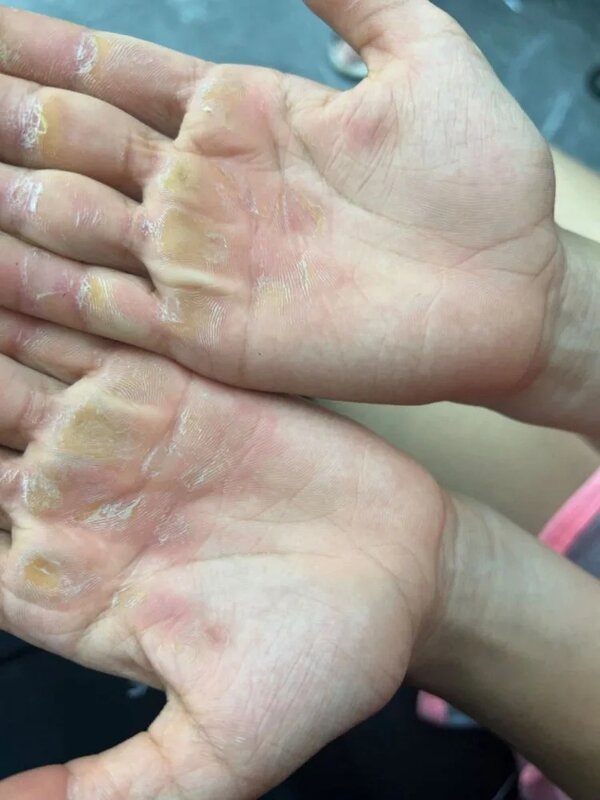 5 小小年紀雙手因為練習攀岩長滿了繭。（圖：戚鉦溵媽媽提供）.jpg