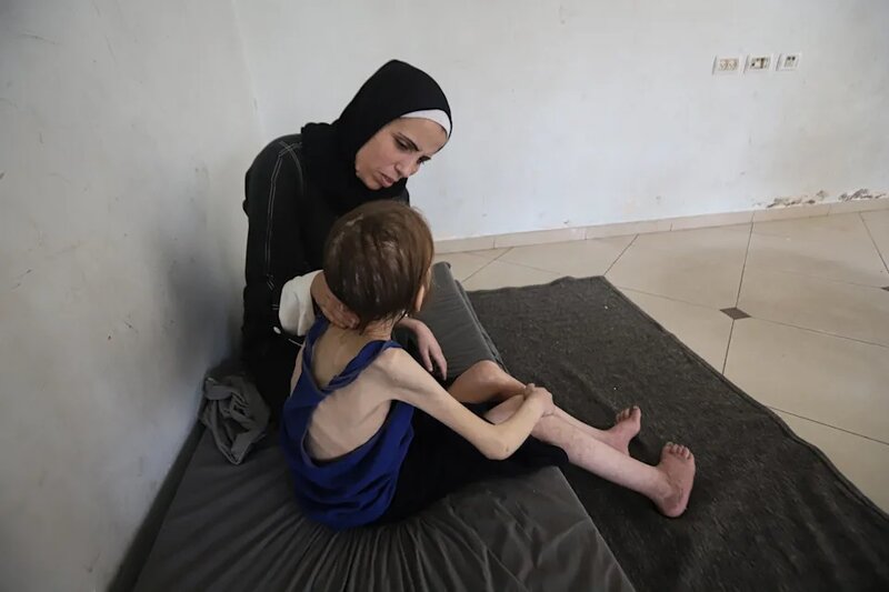 2 母親 Shuruk Ayyad 說，女兒現在連走路也有困難，頭髮脫落，已影響她的情緒和心理健康。.jpg