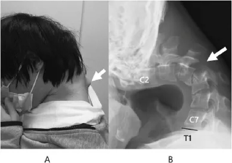 1 日本男長期低頭玩機患罕有「垂頭症」 頸椎 90 度畸形後頸「長角」劇痛半年.jpg