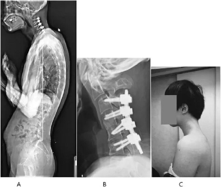 3 日本男長期低頭玩機患罕有「垂頭症」 頸椎 90 度畸形後頸「長角」劇痛半年.jpg