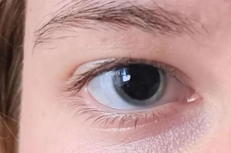 女子瞳孔離奇放大，網民催促求醫救回一命。(Reddit).jpg