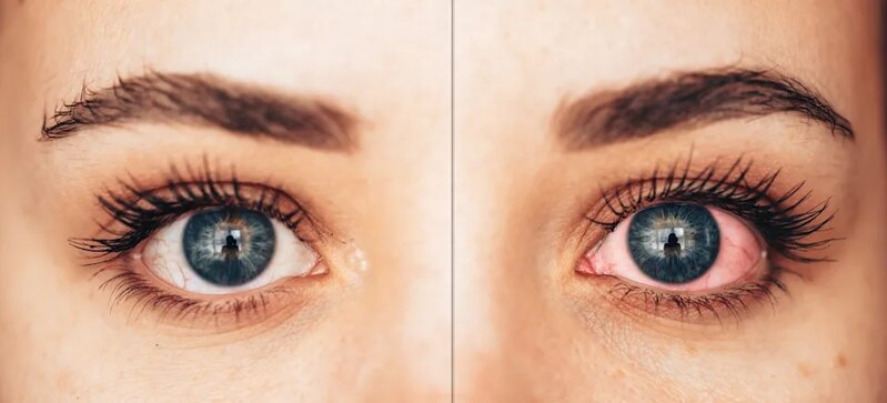 2 One healthy and diseased female eye in blue..jpg