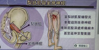 梨状肌发炎经佳佳技师手法理疗后得到明显缓解的体验反馈